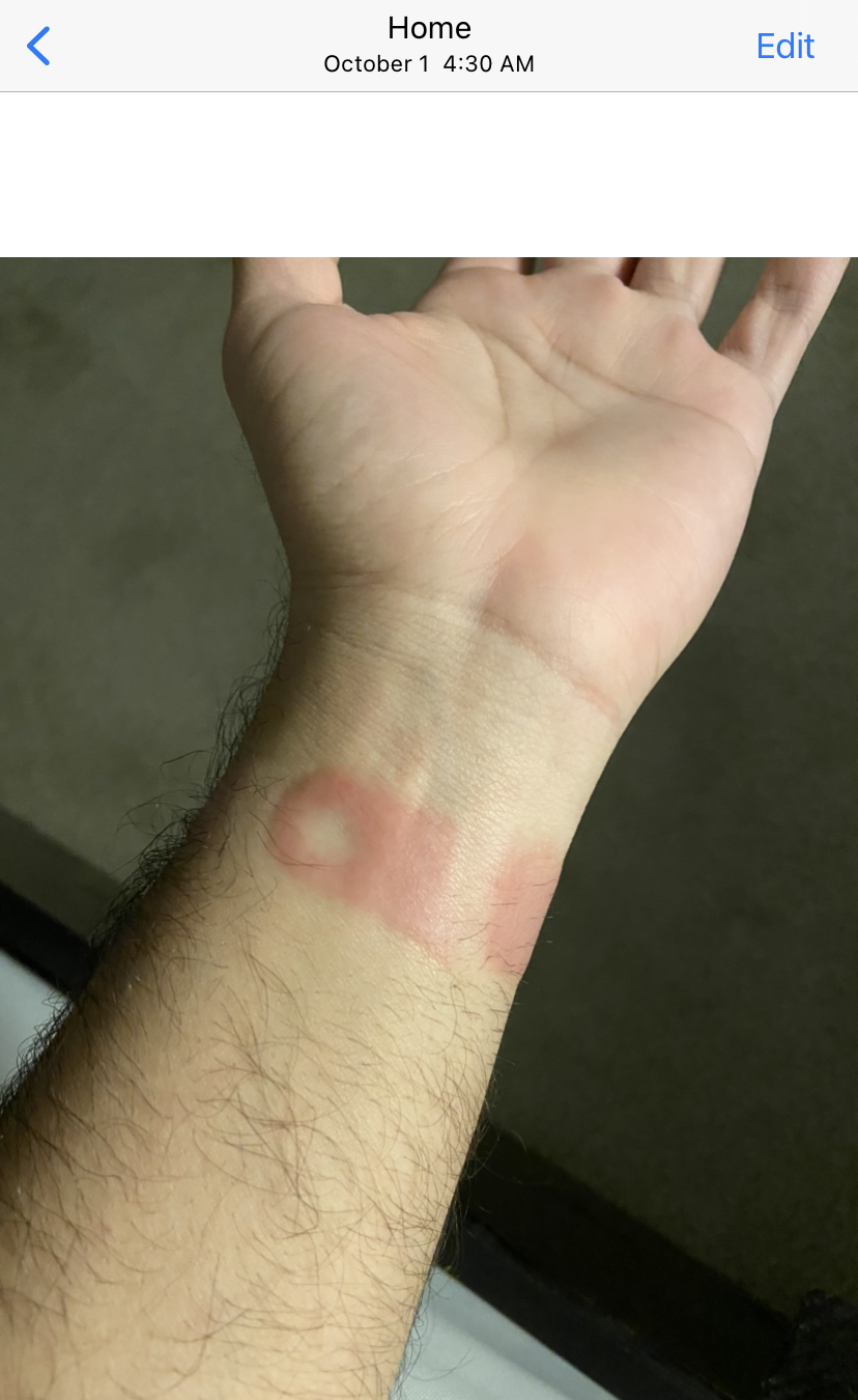 My Apple Watch Series 6 Band burned me? | MacRumors Forums