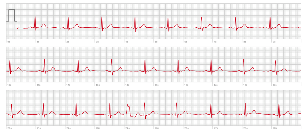ecg.png