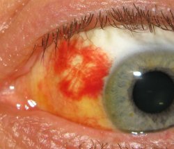 blood-eye.JPG