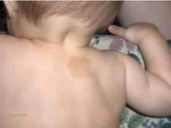 steve applbirthmark.jpg