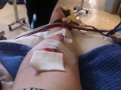 Arm punctured for platelets 20120510.jpg