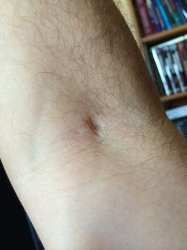Donation scars.jpg