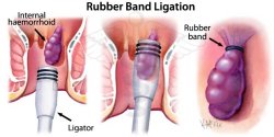 rubber-band-ligation.jpg