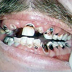 tv_rotten-teeth_22se.jpg