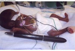 capt.48fa7cb426b64ceaa7aecd9d249c4f66.the_worlds_youngest_gestational_age_baby__born_at_21_weeks_and