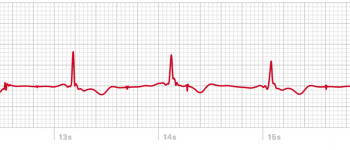 ECG-2-AW.png