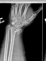 WristB4.jpg