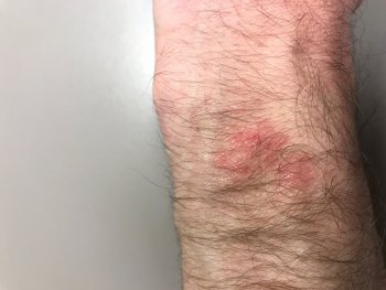 Feb2019_AppleWatch_Burn1.jpg