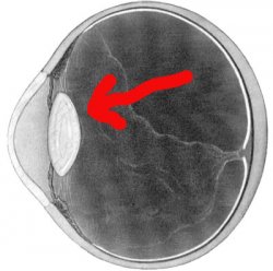 Macula_hole_fig_1.jpg