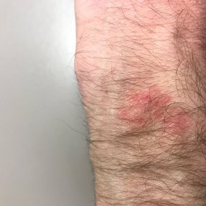 Feb2019_AppleWatch_Burn1.jpg
