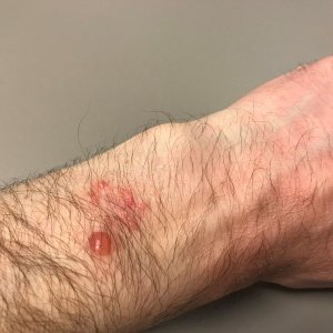 Feb2019_AppleWatch_Burn2.jpg