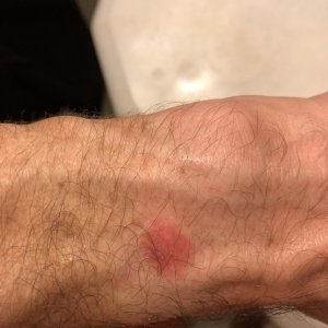 July2020_AppleWatch_Burn1.jpg