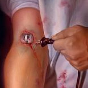 arm_plug.jpg
