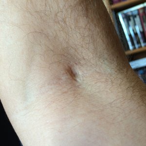 Donation scars.jpg