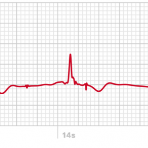 ECG-2-AW.png