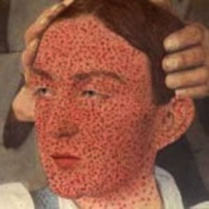 smallpox.jpg