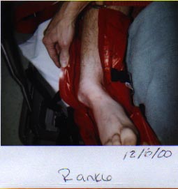 Daves ankle.jpg