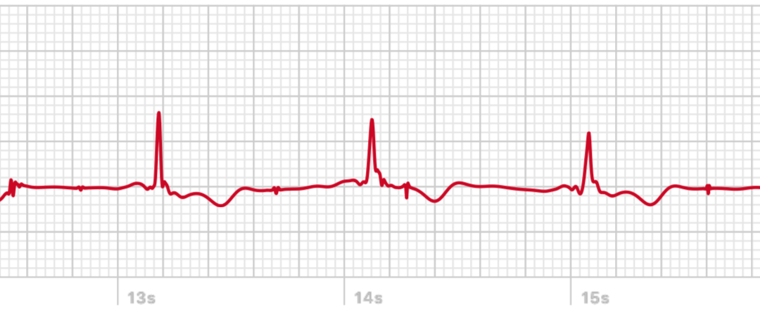 ECG-2-AW.png