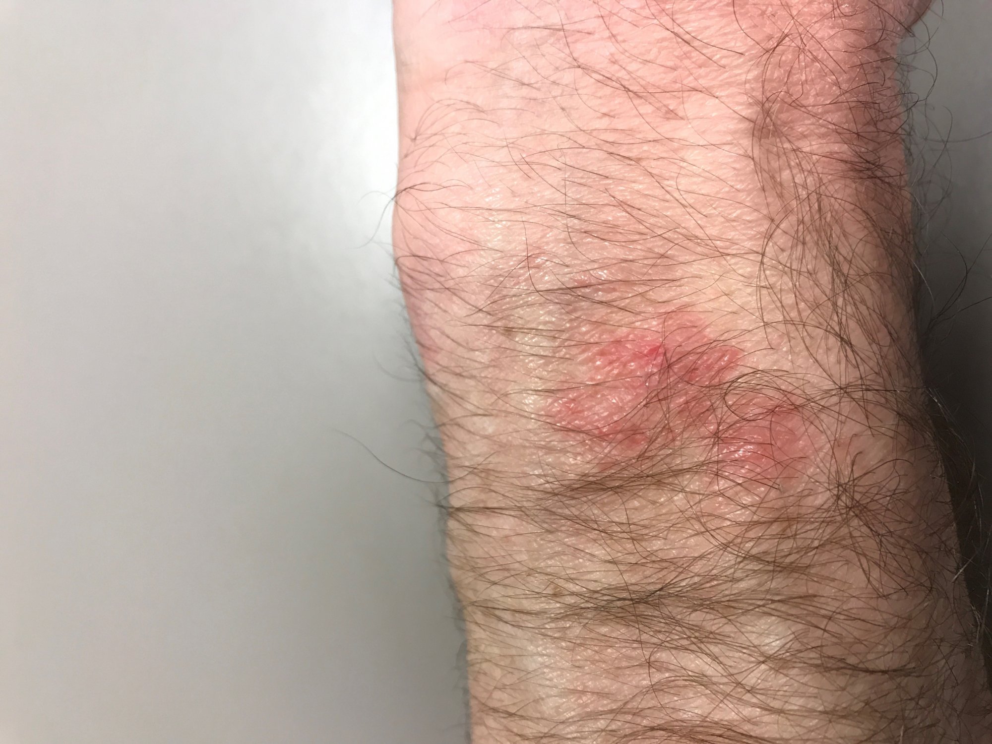 Feb2019_AppleWatch_Burn1.jpg