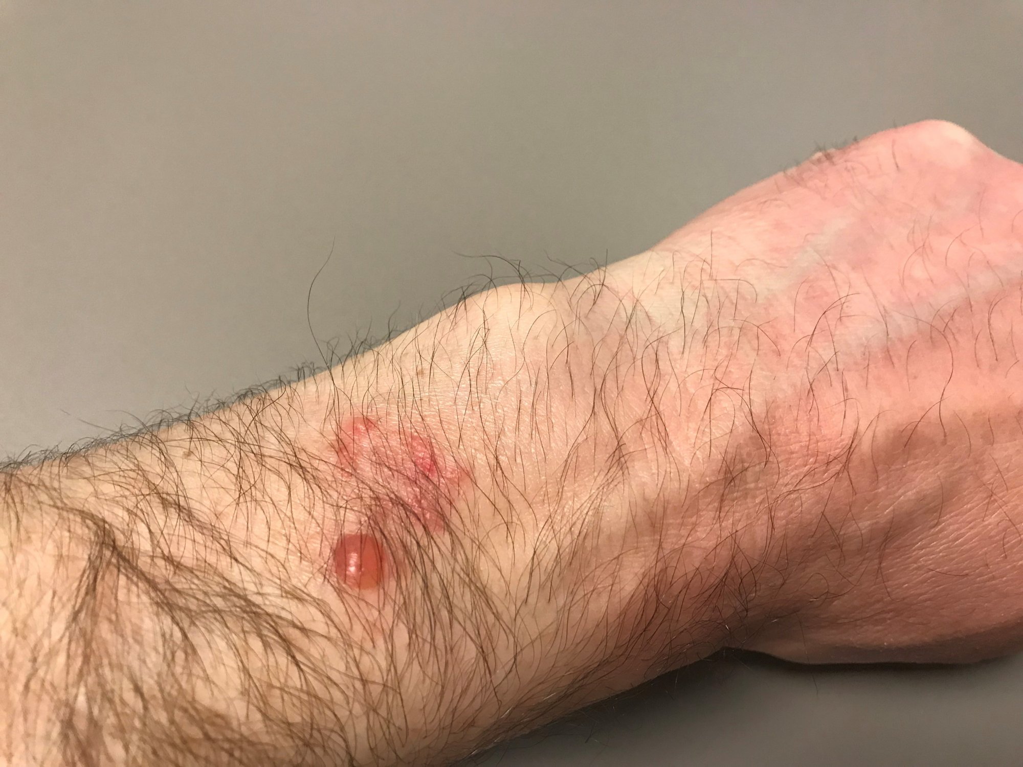 Feb2019_AppleWatch_Burn2.jpg