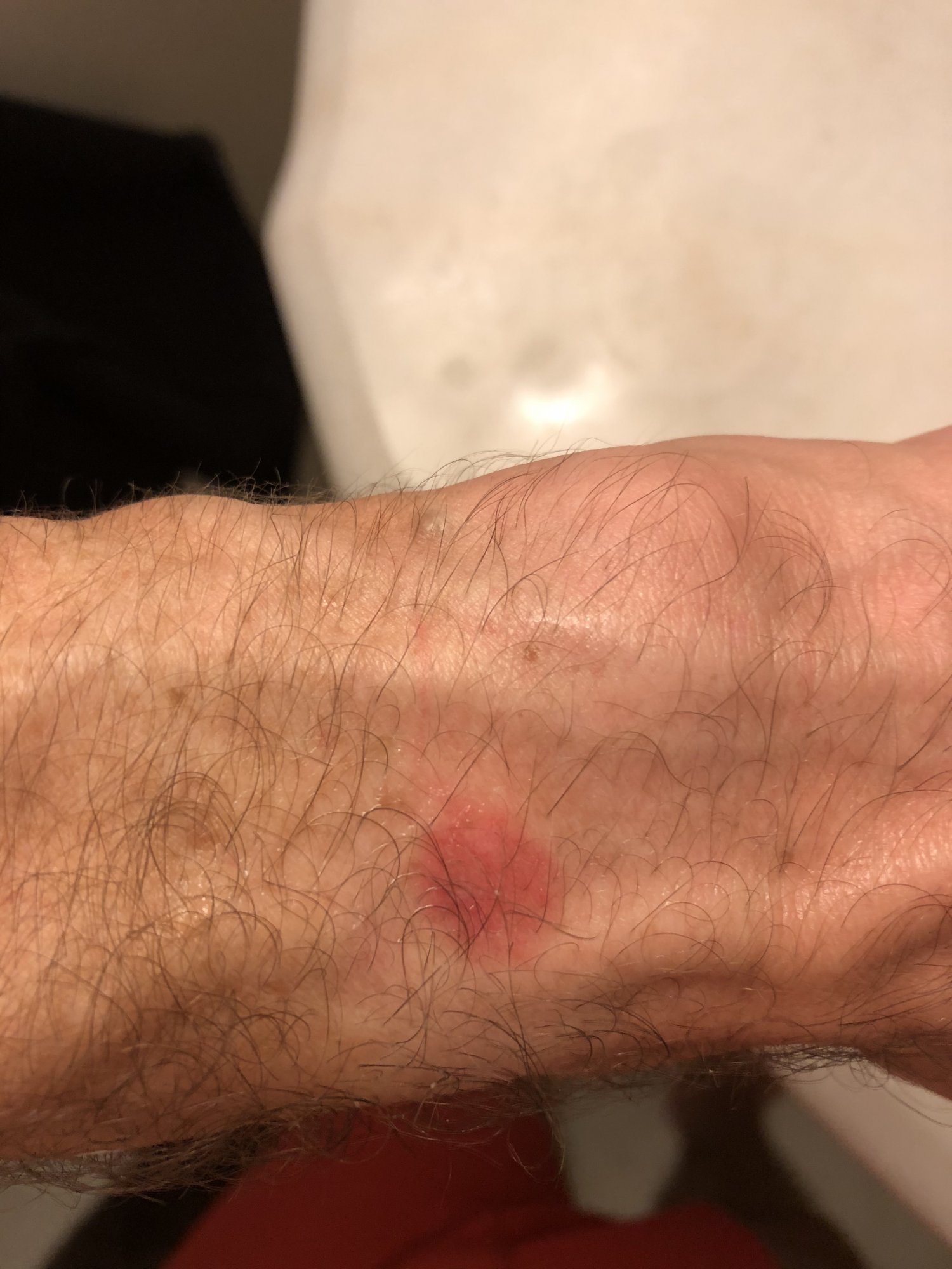 July2020_AppleWatch_Burn1.jpg