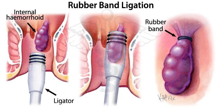rubber-band-ligation.jpg