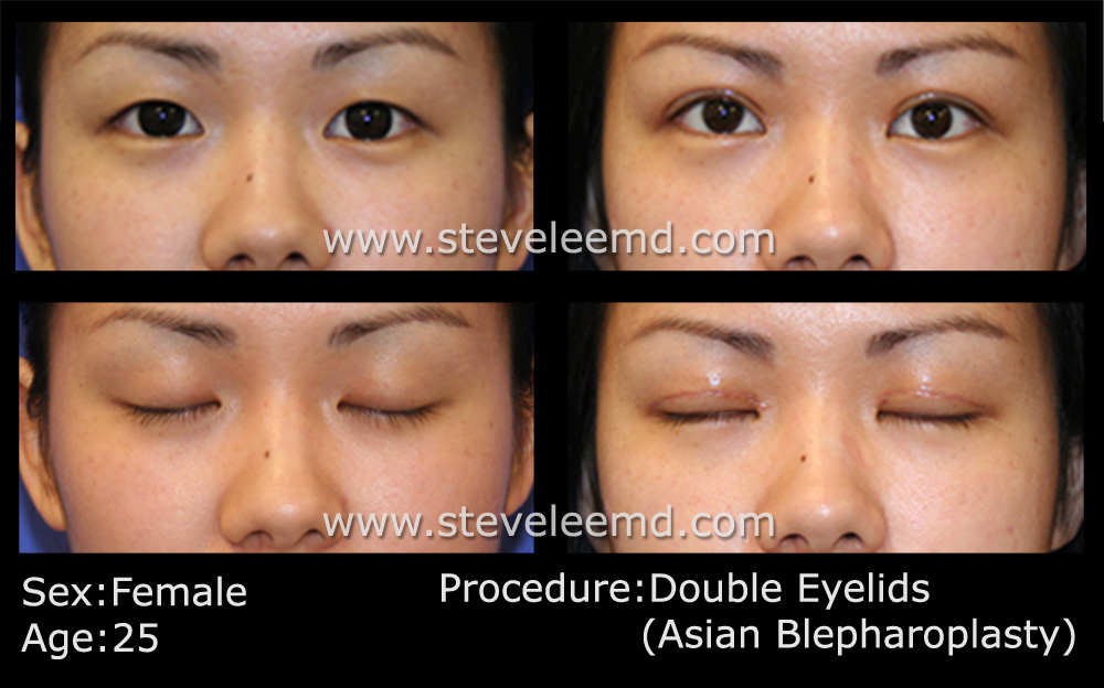 doubleeyelid_eng2.jpg