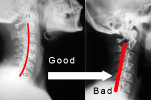 neckcervxray.jpg
