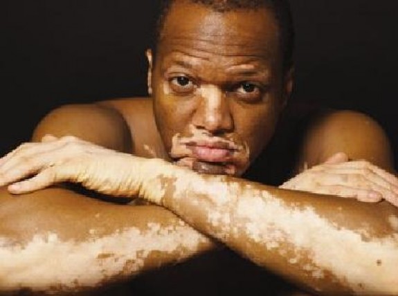 man-with-vitiligo.jpg